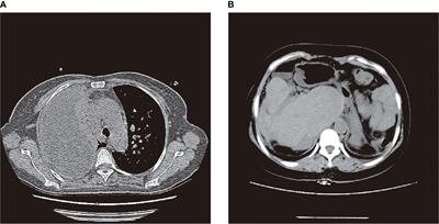 First case report of spontaneous biliary pleural fistula diagnosed using near infrared region I/II fluorescence of indocyanine green